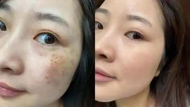 祛斑霜效果最好的排名第一淡斑祛斑见效超快