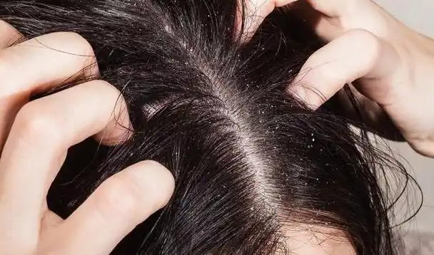 头痒头皮屑多是怎么回事(医生总结头屑头痒的四个诱因)