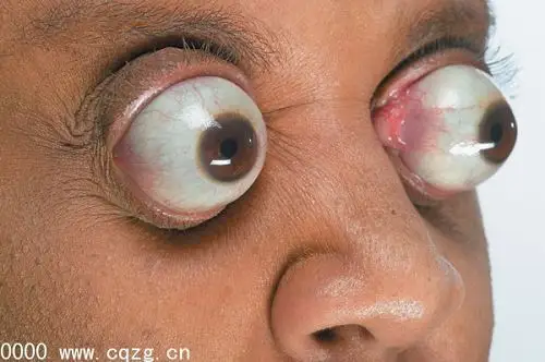 世界上眼球最突出的人(恐怖图)