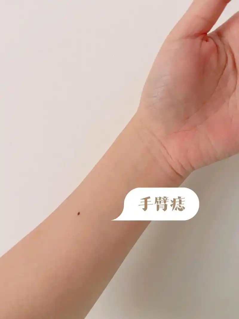 长大了发现痣也长大 	 这个痣一直挺喜欢的,看着顺眼 	 大师说手腕痣