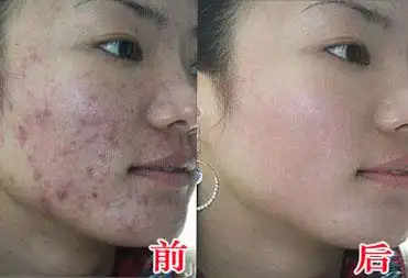 果酸换肤,对比图,长春好的整形医院