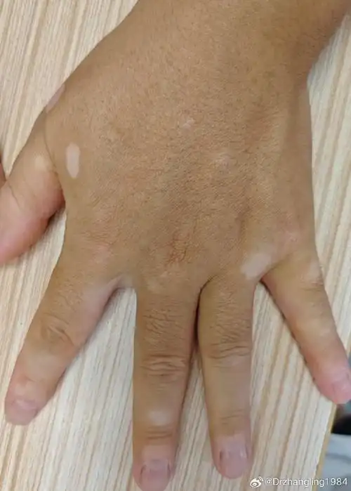 **皮肤保护**:避免皮肤受损,避免使用增白化妆品,减少阳光曝晒,尤其