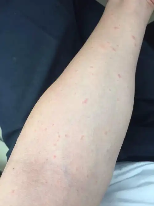 我这是湿疹还是过敏性皮炎?