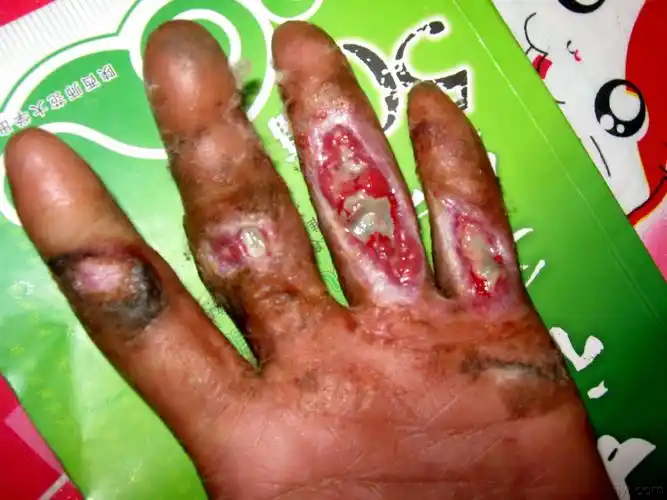 伤愈膏的功效主要对长期不愈合的伤口骨外露烧伤有独特的疗效