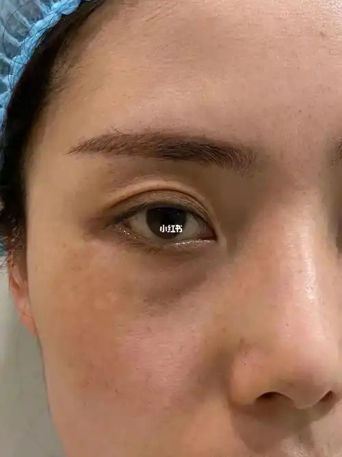 眼窝填充_华山名邸攻略_脂肪填充_脂肪填充眼窝_美妆_医美整形