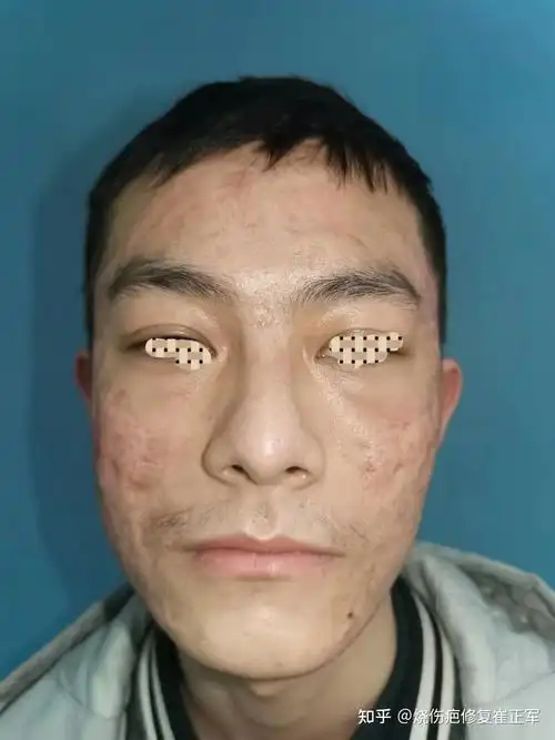 一例严重面部痤疮凹陷性瘢痕的治疗分析 - 知乎
