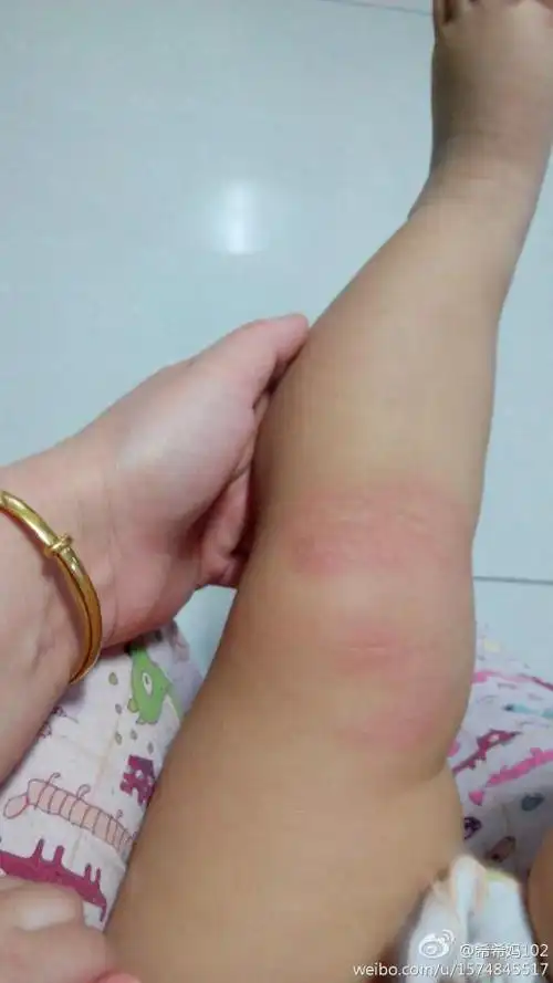 健康 儿科 吃了几根虾条,可吃虾不过敏啊,急死了,盼回复