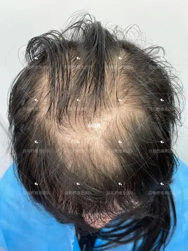 这种稀疏程度完全可以手术了头发少的可怜