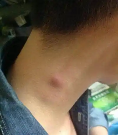 脖子长出"肉疙瘩"要重视,每天用小食材泡水喝,排出毒素人