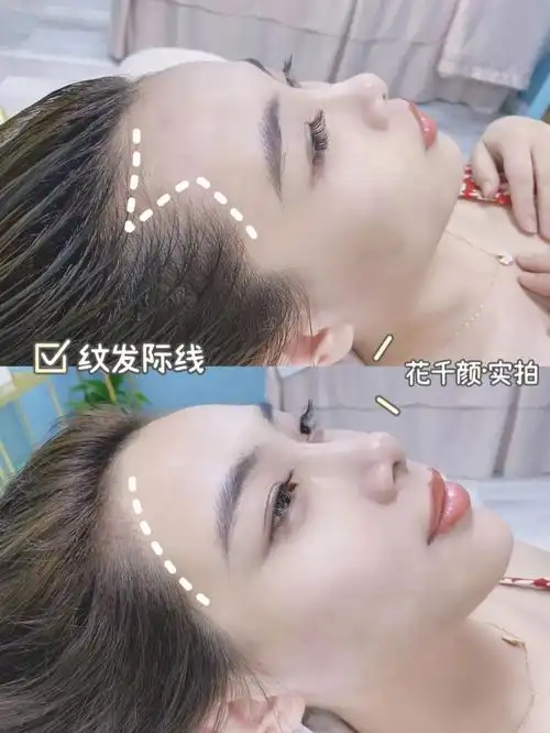 发际线高怎么办做半永久