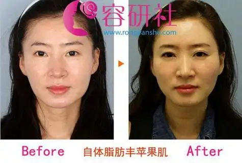 自体脂肪填充苹果肌前后对比