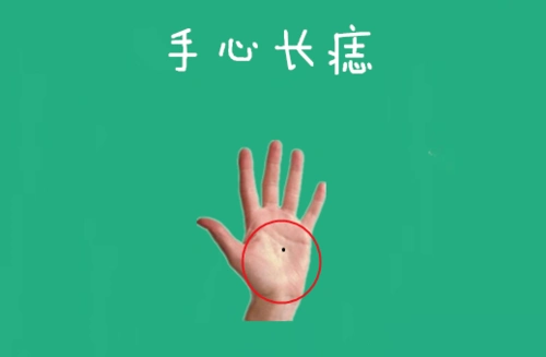 手心长痣