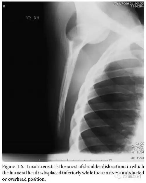 直举性肱骨脱位:罕见的肩关节脱位,肱骨头向下异位,而胳膊上举.