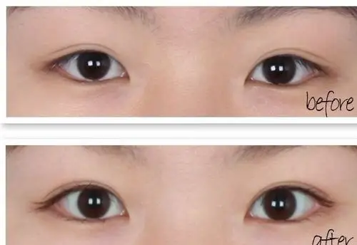单眼皮和双眼皮的区别在哪里?
