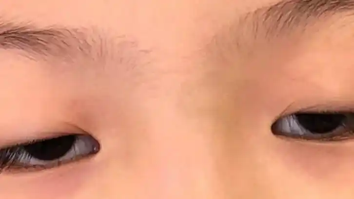 重症肌无力在发病前,会出现"预警信号",大多数患者都忽视了!