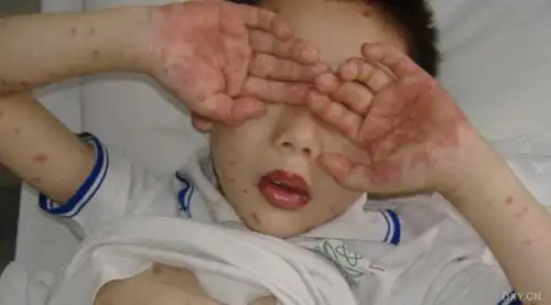 【资料】发1张手足口病图片