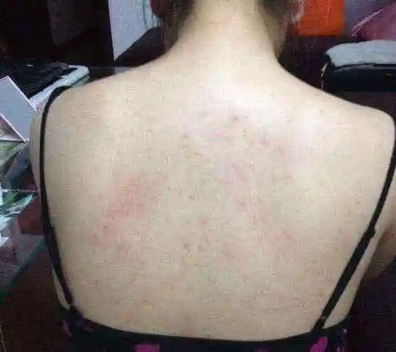 背部感染螨虫,会导致背部油腻,刚洗完澡不久后背就开始出油了,用指甲