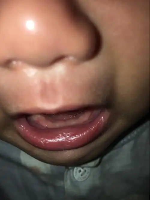 4个月宝宝,牙龈上白色的东西是什么?不会是长牙的前奏吧?