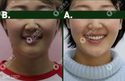 整牙前后的笑容对比 图源www.bjqnw.com