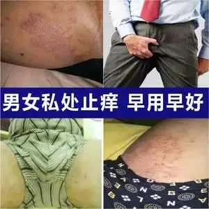外阴瘙痒止痒膏阴毛痒女性阴痒王私处下面阴道痒的药霉菌女妇科男