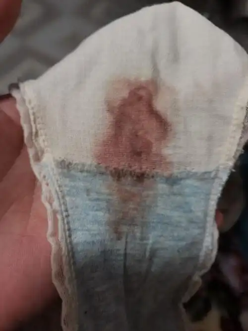 昨天去上医院检查了,昨天就内裤上的那一些,也没有流那么多血