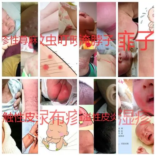 八种皮肤病图片辨认