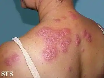 根治顽固性皮肤病的几种方法?去老年斑偏方