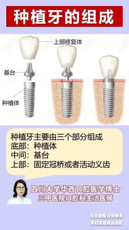 种植牙都由哪些部分组成呢?张医生今天大家一 - 抖音