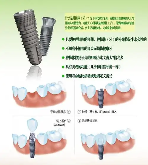 种植牙示意图