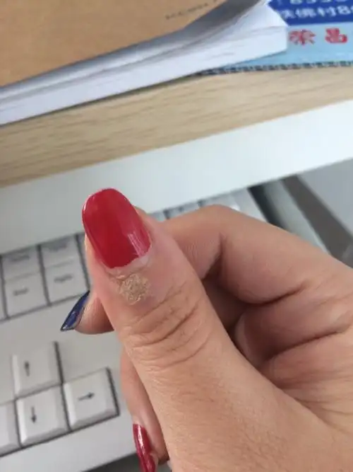 手指甲盖下方的肉刺好不了