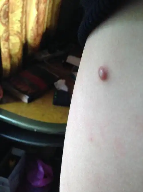 腋窝下面长了颗疙瘩请问这是什么情况