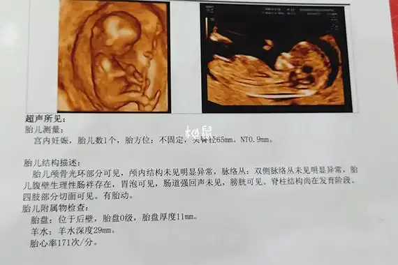 13周已生男宝nt单子数据分享,原来看三个亮点就知男孩女孩 - 柚鼠知识