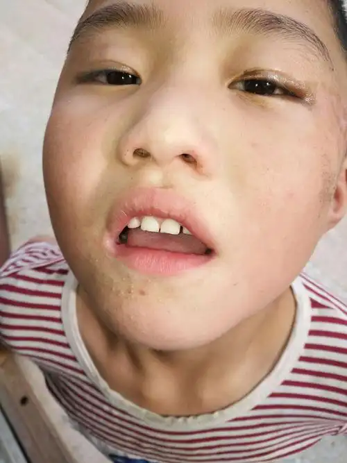 儿童面部扁平疣治疗中