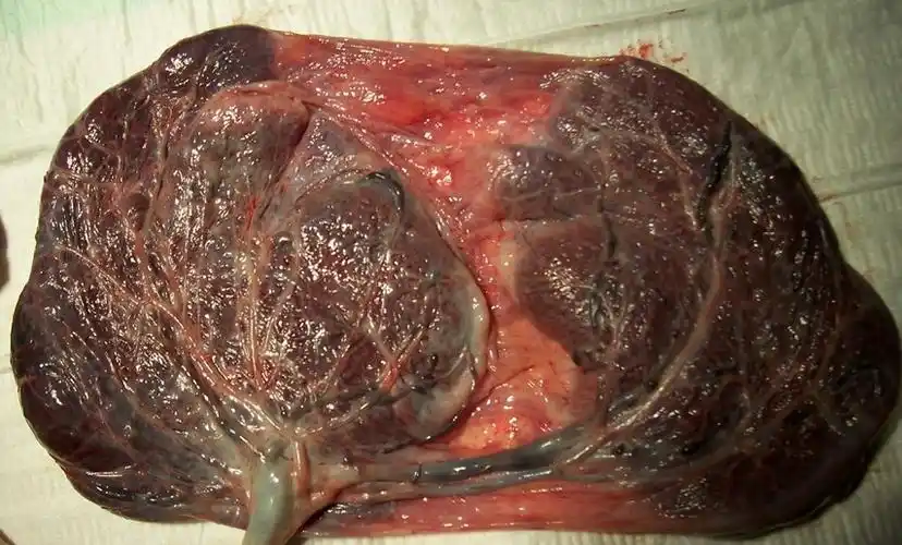 产后有胎盘残留怎么办 产后有胎盘残留怎么办呢