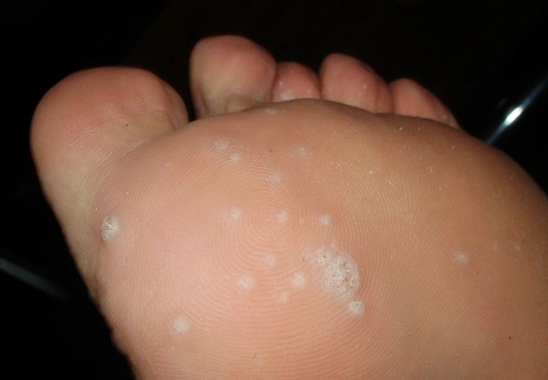 脚上起水泡怎么处理?3个简单方法,轻松解决水泡困扰!