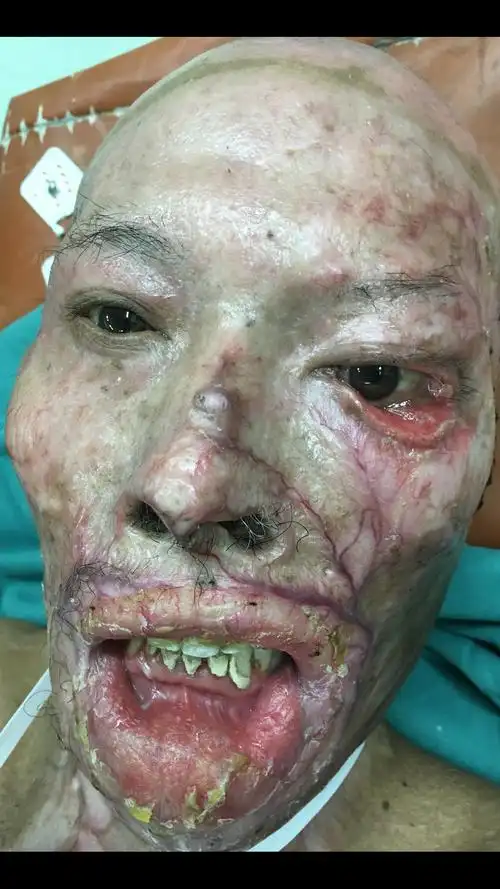 烧伤后左下眼睑外翻畸形植皮修复手术前后照片