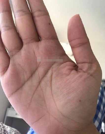 金星丘有痣富裕之象只要持之以恒好日子等着你