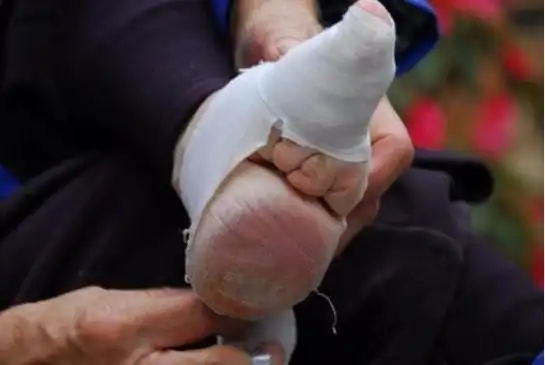 绑脚时,除拇指外的四指弯曲在脚底,用白布包紧.