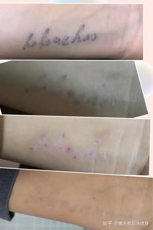洗纹身案例