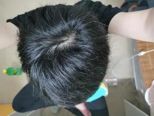 姊妹们,我这样是秃顶的前期吗
