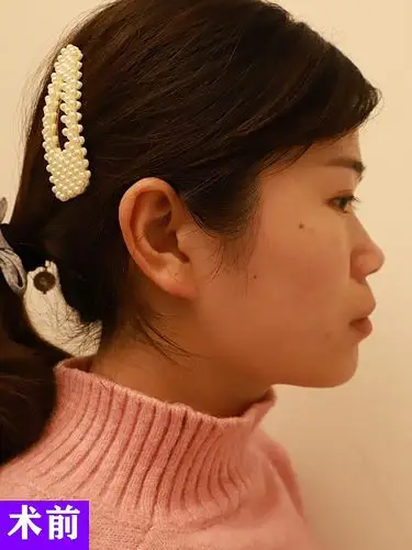 术前诊断鼻梁低,山根低,鼻子塌扁,鼻头肥大,鼻小柱_圈子-新氧美容整形