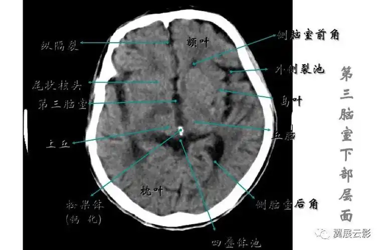 颅脑常见疾病ct诊断