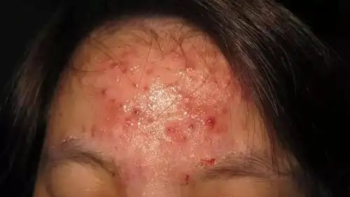 长痘?问题肌?这些修复法则你需要知道_皮肤