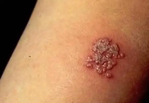 各种类型的皮炎都有什么症状