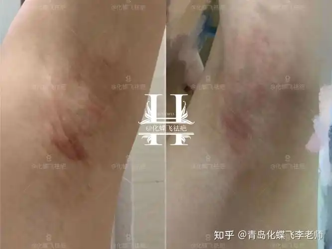 四川成都,虽说新的腋下手术技术创面小,但是皮下黏连和刀口增生也很难