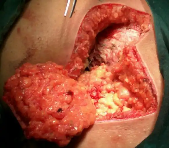 藏毛窦切除一例