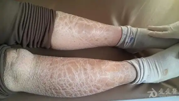 请诊断--双小腿皮肤病变