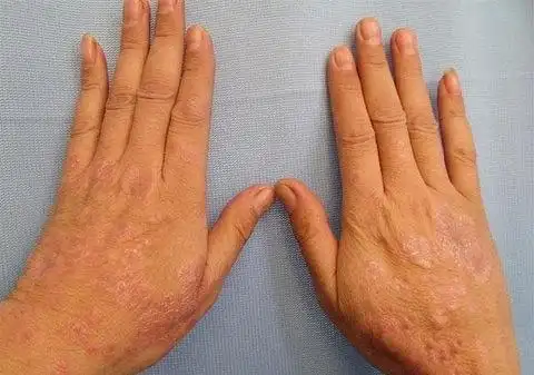 各种癣的症状图片及名称