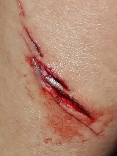 当时就做了消毒和包扎,伤口并不怎么疼(还坚持骑了40公里回家),今天
