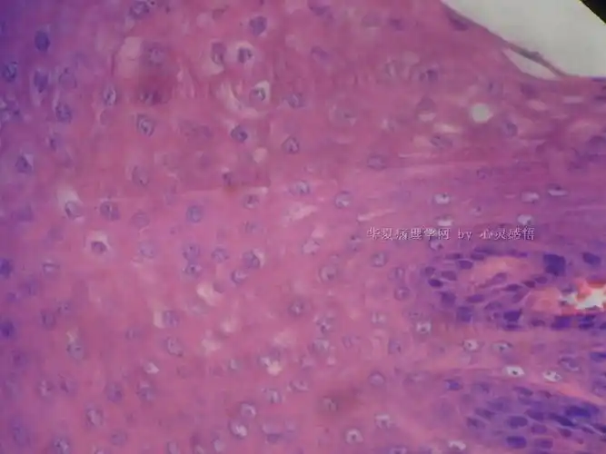 悬雍垂乳头状瘤?